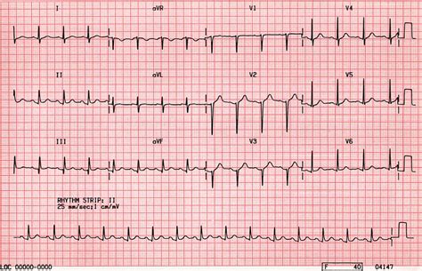 anteroseptal infarct old on ekg.